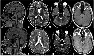 Case report: Early-onset parkinsonism among the neurological features in children with PHACTR1 variants